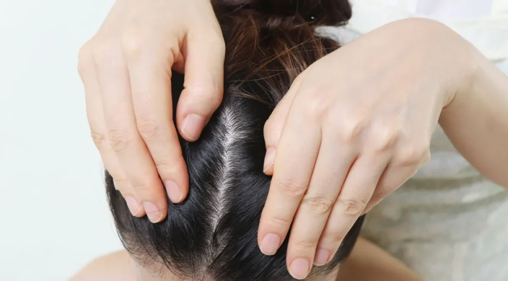Câncer de pele também pode afetar o couro cabeludo; veja como prevenir