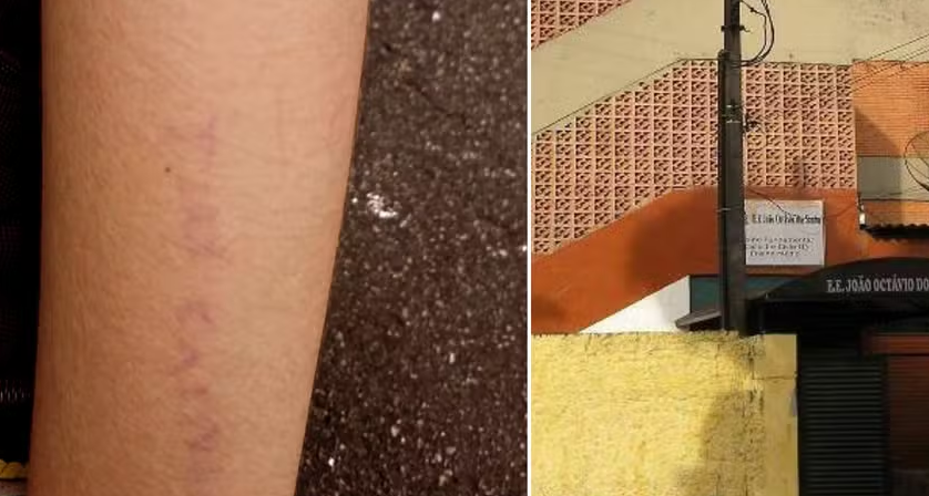 Menino com autismo sofre bullying e é rabiscado nos braços, testa e nuca em escola no litoral de SP