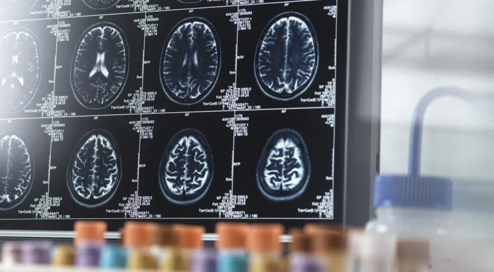 Estudo mostra fatores de risco que podem causar envelhecimento cerebral precoce