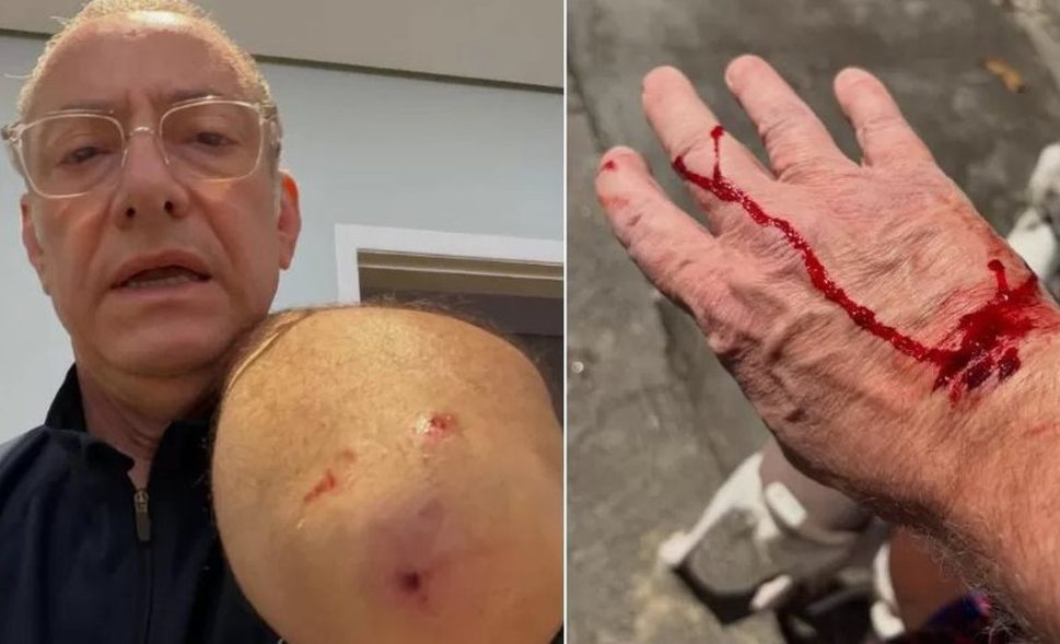 Jornalista da Globo é atacado por pitbull sem guia